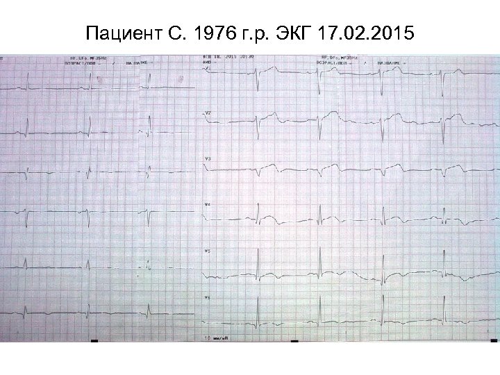Пациент С. 1976 г. р. ЭКГ 17. 02. 2015 
