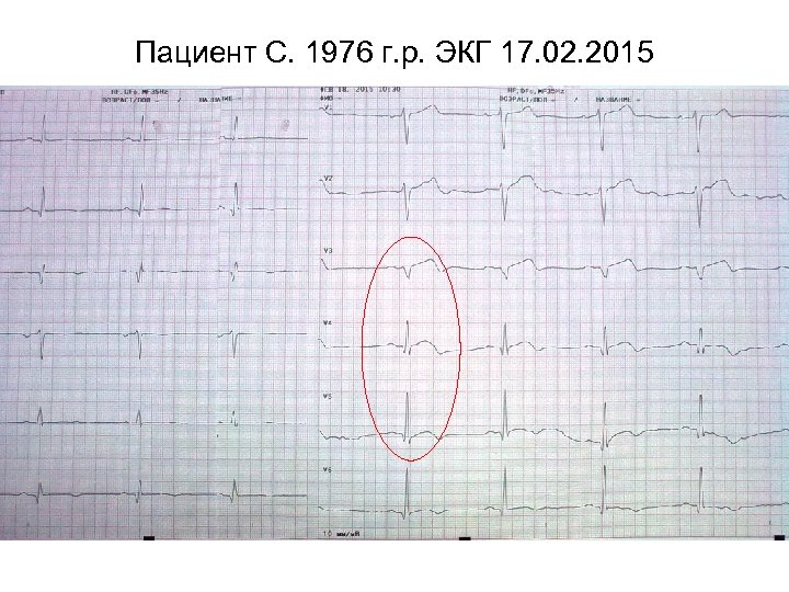 Пациент С. 1976 г. р. ЭКГ 17. 02. 2015 