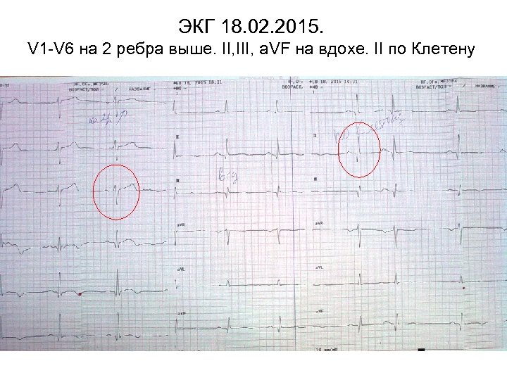 ЭКГ 18. 02. 2015. V 1 -V 6 на 2 ребра выше. II, III,