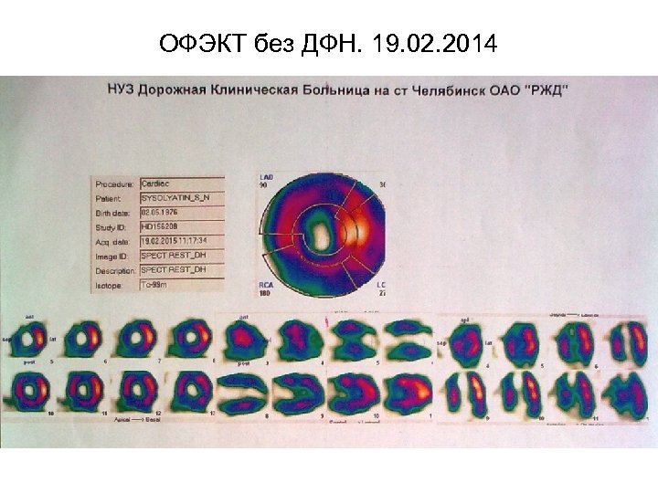 ОФЭКТ без ДФН. 19. 02. 2014 