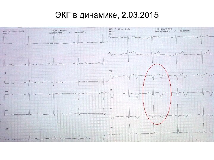 ЭКГ в динамике, 2. 03. 2015 