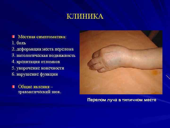 КЛИНИКА Местная симптоматика: 1. боль 2. деформация места перелома 3. патологическая подвижность 4. крепитация
