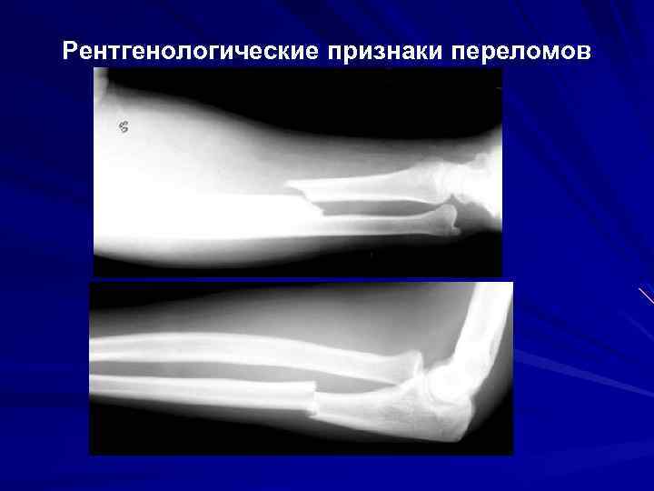Рентгенологические признаки переломов 