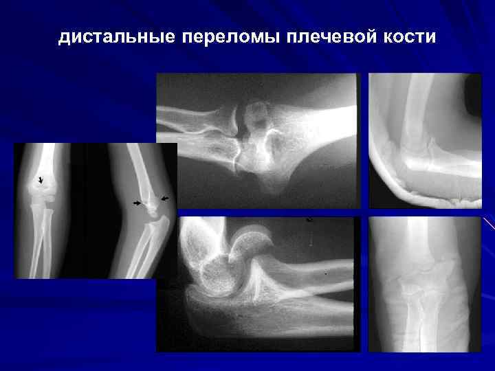 дистальные переломы плечевой кости 