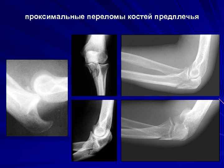 проксимальные переломы костей предплечья 