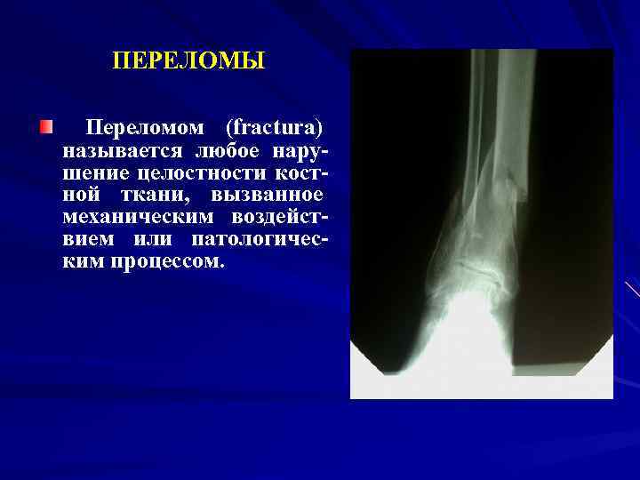 ПЕРЕЛОМЫ Переломом (fracturа) называется любое нарушение целостности костной ткани, вызванное механическим воздействием или патологическим