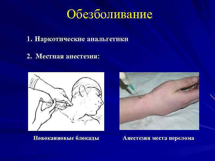 Обезболивание 1. Наркотические анальгетики 2. Местная анестезия: Новокаиновые блокады Анестезия места перелома 
