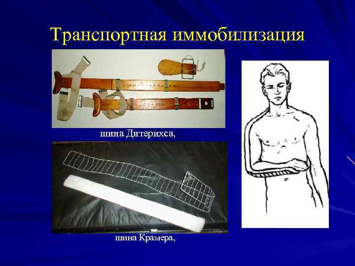 Транспортная иммобилизация шина Дитерихса, шина Крамера, 