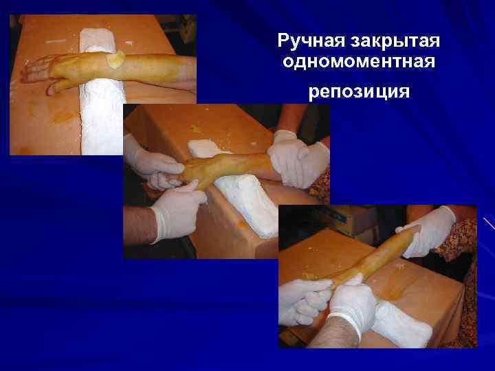 Ручная закрытая одномоментная репозиция 