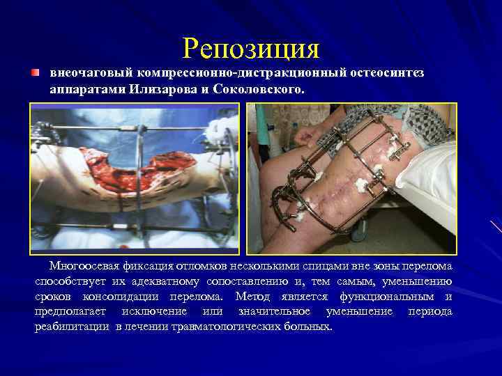 Репозиция внеочаговый компрессионно-дистракционный остеосинтез аппаратами Илизарова и Соколовского. Многоосевая фиксация отломков несколькими спицами вне