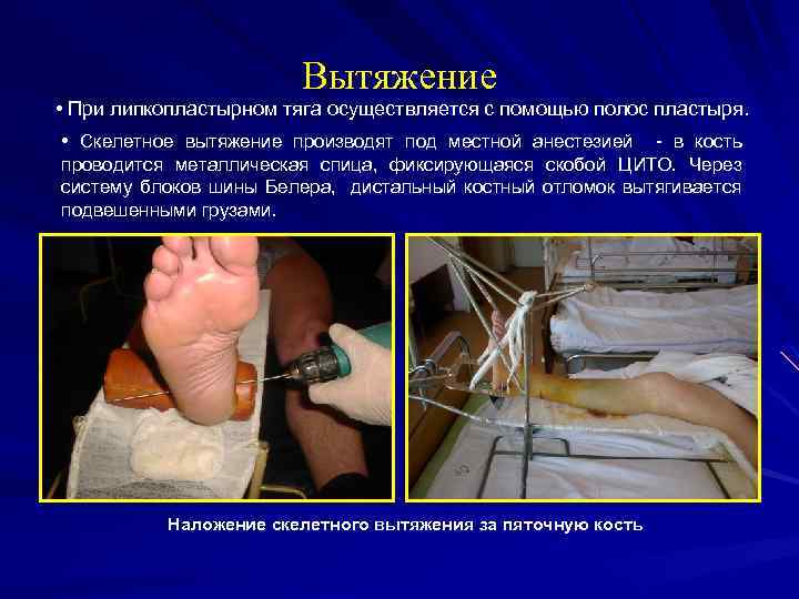 Вытяжение • При липкопластырном тяга осуществляется с помощью полос пластыря. • Скелетное вытяжение производят