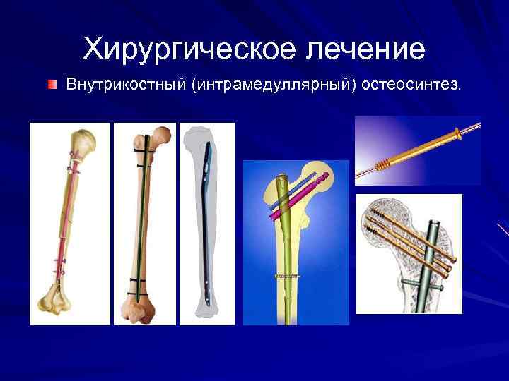 Хирургическое лечение Внутрикостный (интрамедуллярный) остеосинтез. 