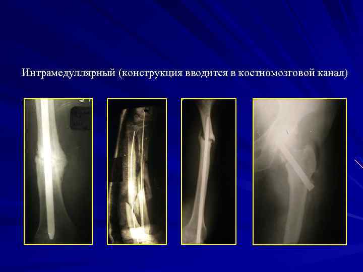 Интрамедуллярный (конструкция вводится в костномозговой канал) 