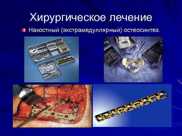 Хирургическое лечение Накостный (экстрамедуллярный) остеосинтез. 