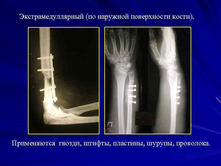 Экстрамедуллярный (по наружной поверхности кости). Применяются гвозди, штифты, пластины, шурупы, проволока. 