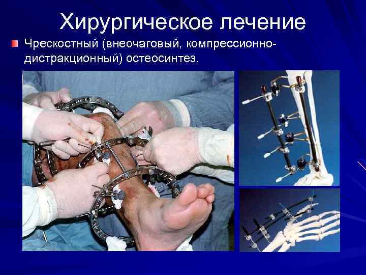 Хирургическое лечение Чрескостный (внеочаговый, компрессионнодистракционный) остеосинтез. 