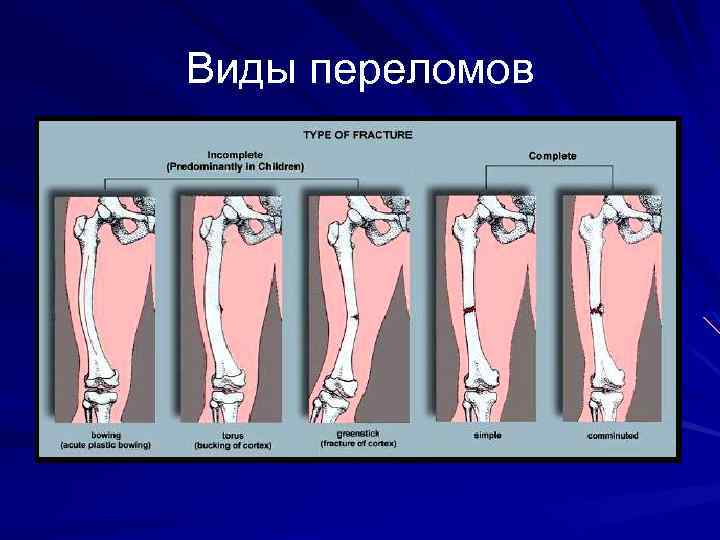 Виды переломов 