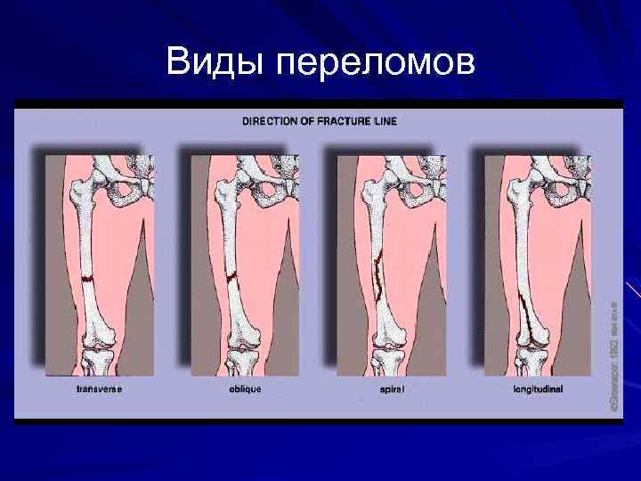 Виды переломов 