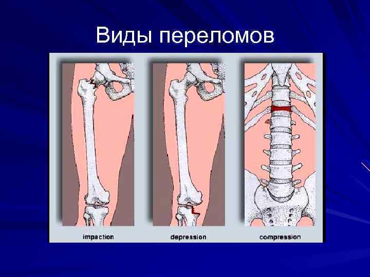 Виды переломов 
