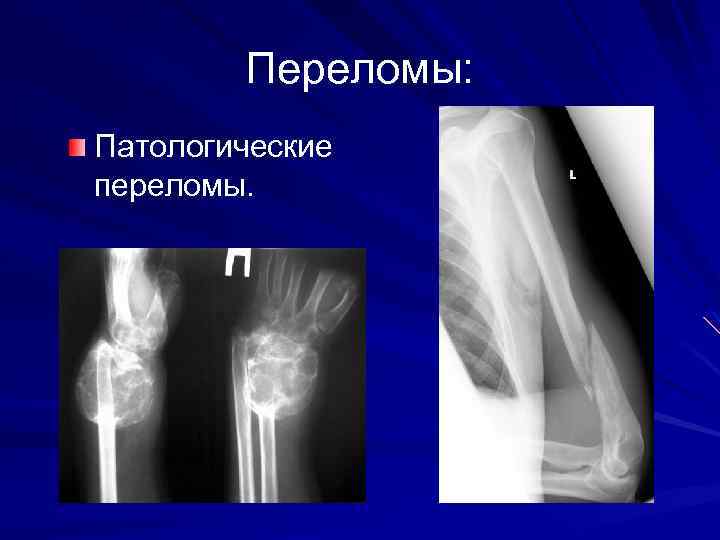Переломы: Патологические переломы. 
