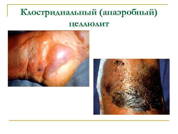Клостридиальный (анаэробный) целлюлит 