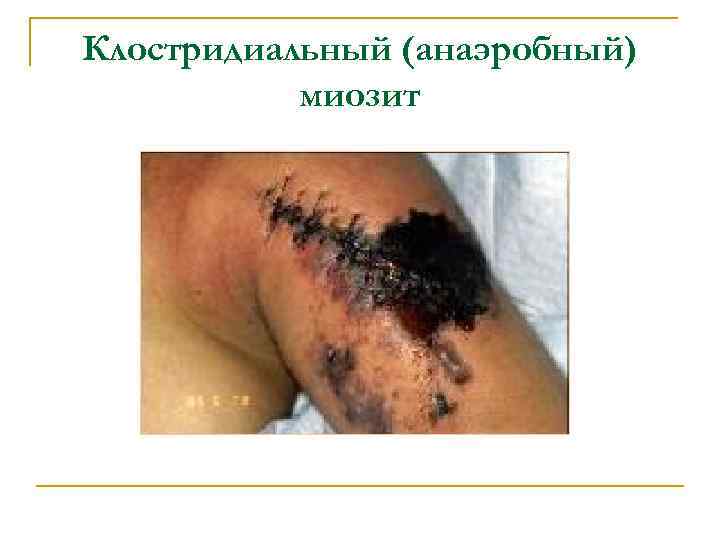 Клостридиальный (анаэробный) миозит 