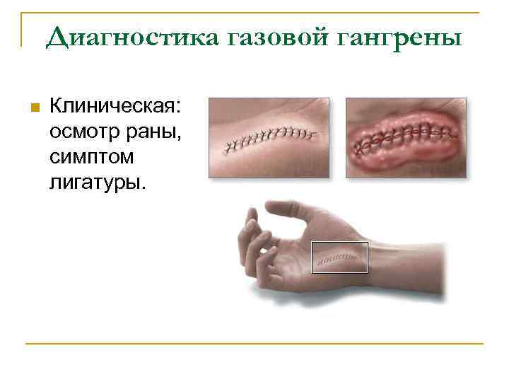 Диагностика газовой гангрены n Клиническая: осмотр раны, симптом лигатуры. 