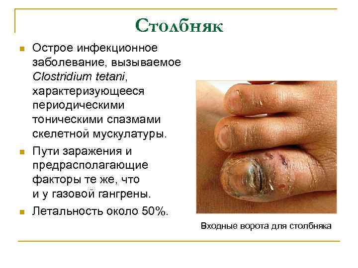 Столбняк n n n Острое инфекционное заболевание, вызываемое Clostridium tetani, характеризующееся периодическими тоническими спазмами