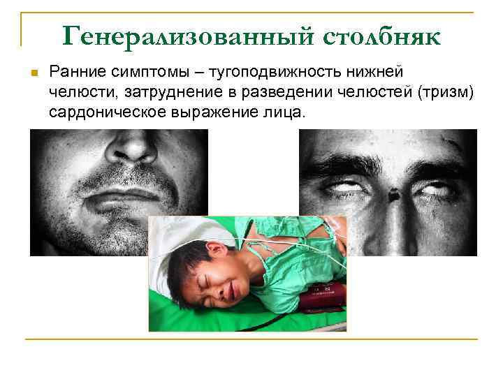 Генерализованный столбняк n Ранние симптомы – тугоподвижность нижней челюсти, затруднение в разведении челюстей (тризм)
