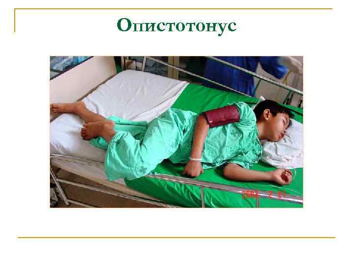 Опистотонус 