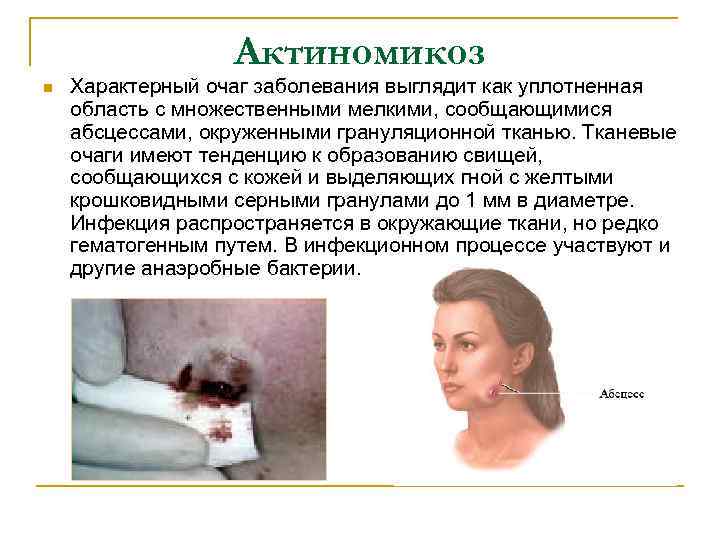 Актиномикоз n Характерный очаг заболевания выглядит как уплотненная область с множественными мелкими, сообщающимися абсцессами,