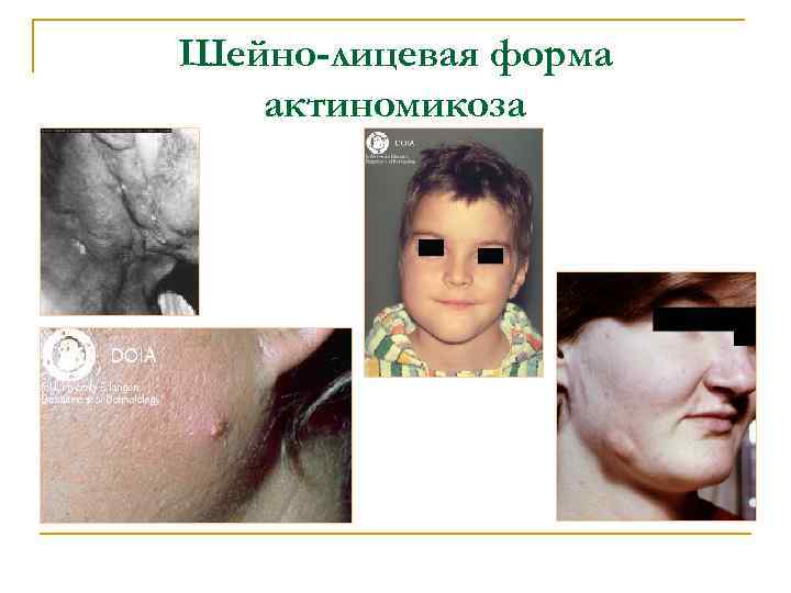 Шейно-лицевая форма актиномикоза 