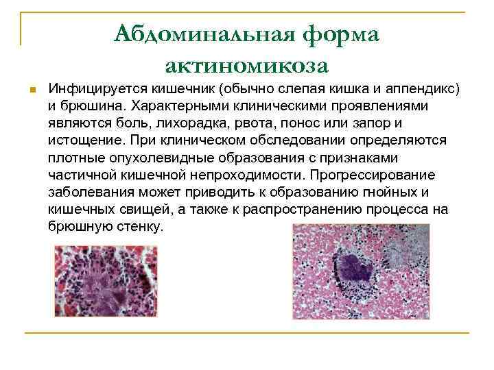 Абдоминальная форма актиномикоза n Инфицируется кишечник (обычно слепая кишка и аппендикс) и брюшина. Характерными