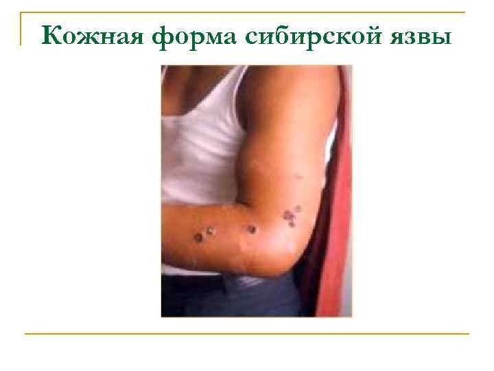 Кожная форма сибирской язвы 
