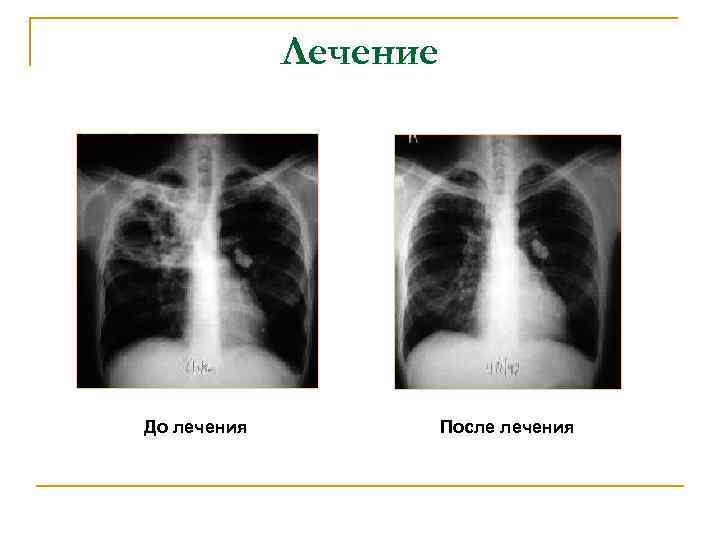 Лечение До лечения После лечения 