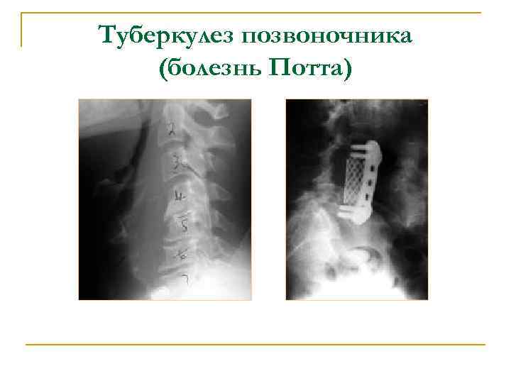 Туберкулез позвоночника (болезнь Потта) 