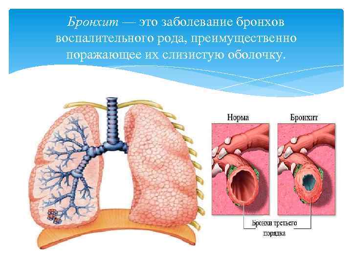 Пылевой бронхит презентация