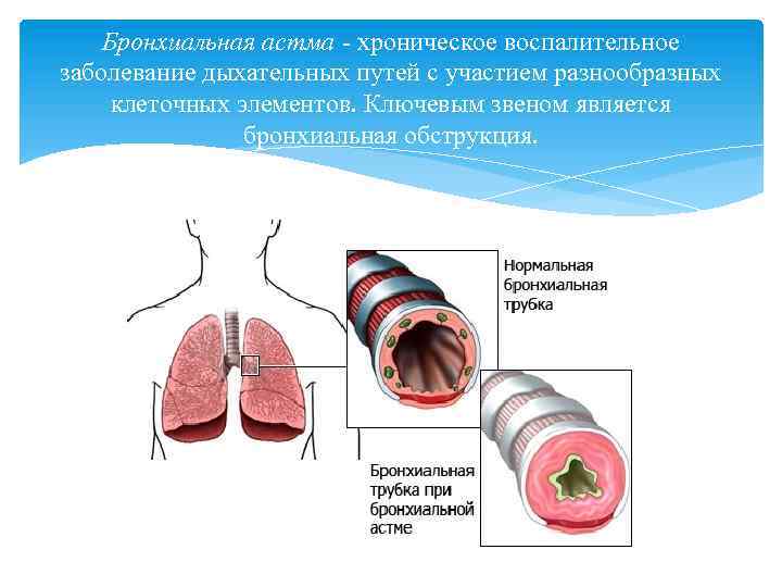 Бронхиальная астма - хроническое воспалительное заболевание дыхательных путей с участием разнообразных клеточных элементов. Ключевым