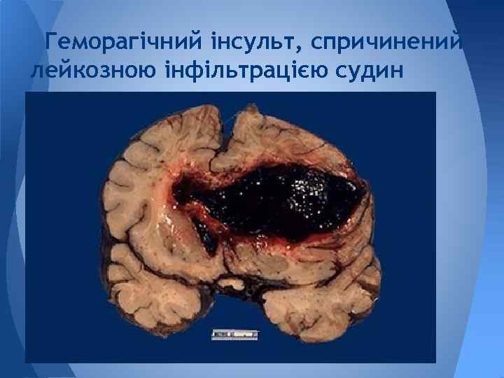 Геморагічний інсульт, спричинений лейкозною інфільтрацією судин 