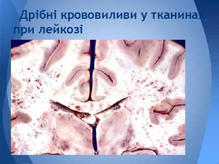 Дрібні крововиливи у тканинах при лейкозі 