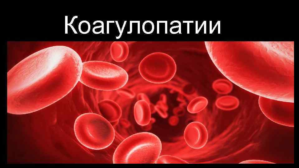 Коагулопатиир 