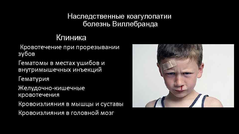 Наследственные коагулопатии болезнь Виллебранда Клиника Кровотечение при прорезывании зубов Гематомы в местах ушибов и