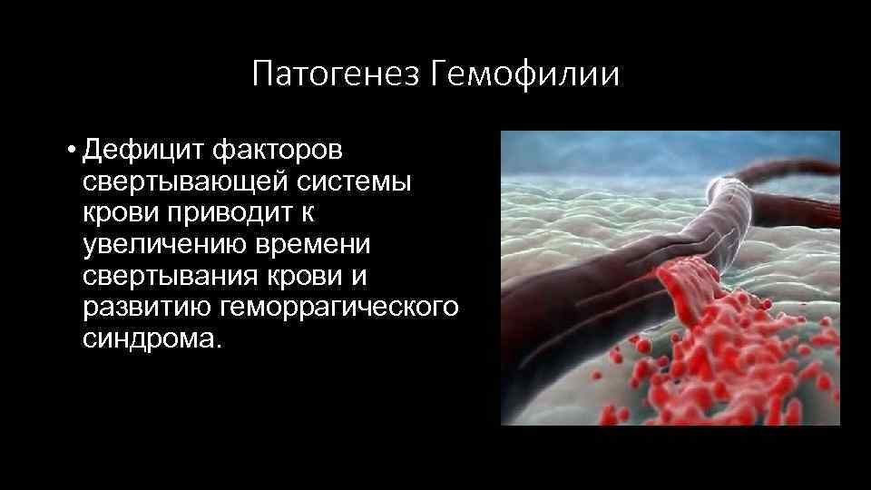 Патогенез Гемофилии • Дефицит факторов свертывающей системы крови приводит к увеличению времени свертывания крови