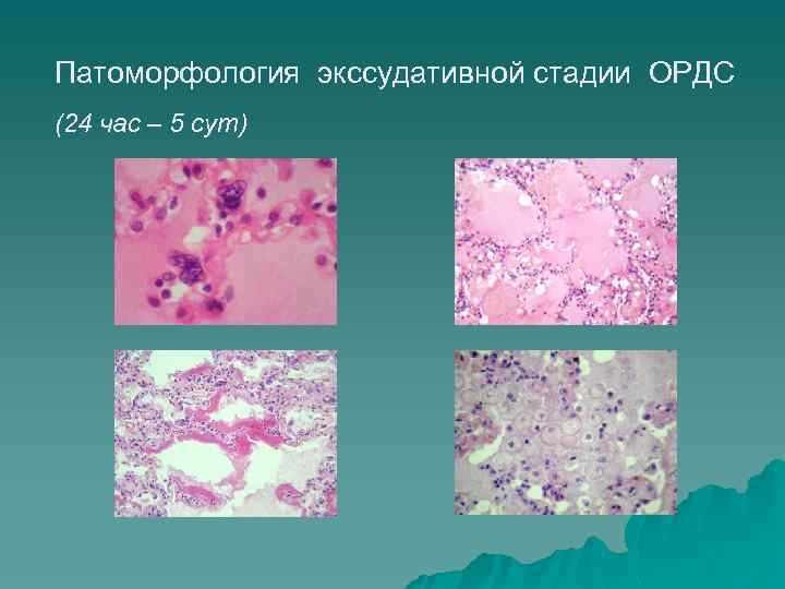 Патоморфология экссудативной стадии ОРДС (24 час – 5 сут) 