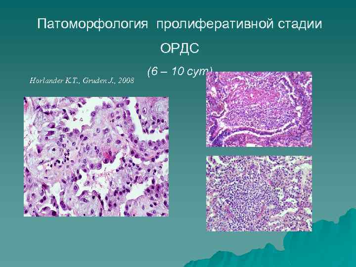 Патоморфология пролиферативной стадии ОРДС Horlander K. T. , Gruden J. , 2008 (6 –