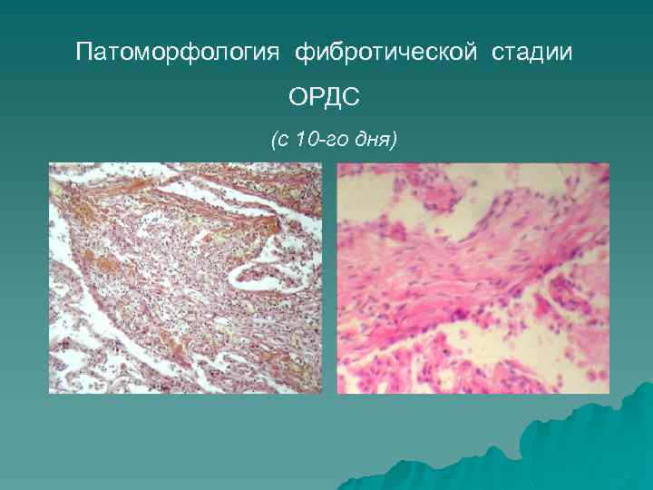 Патоморфология фибротической стадии ОРДС (с 10 -го дня) 