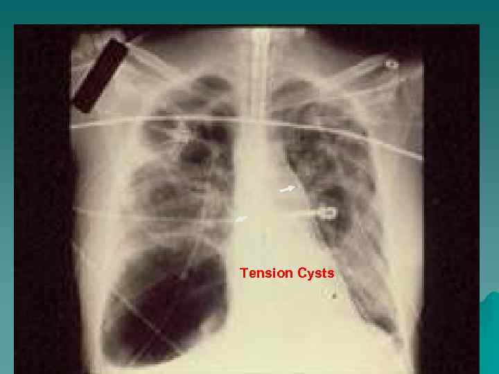 Tension Cysts 