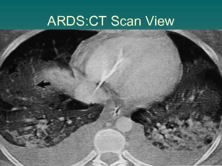 ARDS: CT Scan View 