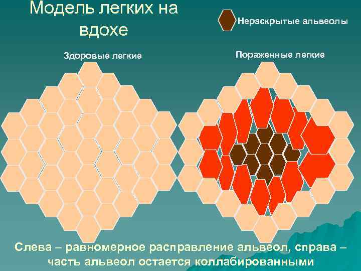 Модель легких на вдохе Здоровые легкие Нераскрытые альвеолы Пораженные легкие Слева – равномерное расправление