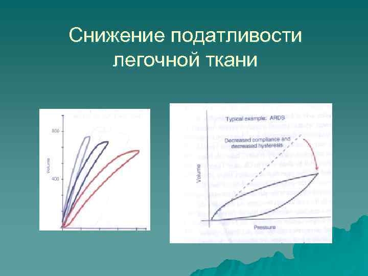 Снижение податливости легочной ткани 